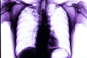 what-is-chronic-lung-disease