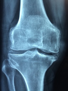 what-to-do-if-your-claim-for-osteoarthritis-disability-is-denied